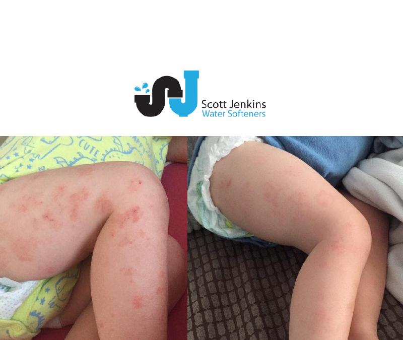Eczema, Your Children and Soft Water