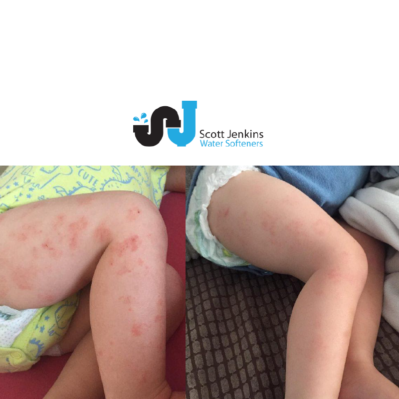 Eczema, Your Children and Soft Water Scott Jenkins Water Softeners in